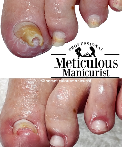 ingrown pincer toenail before and after