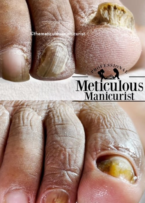 thick toenails before and after